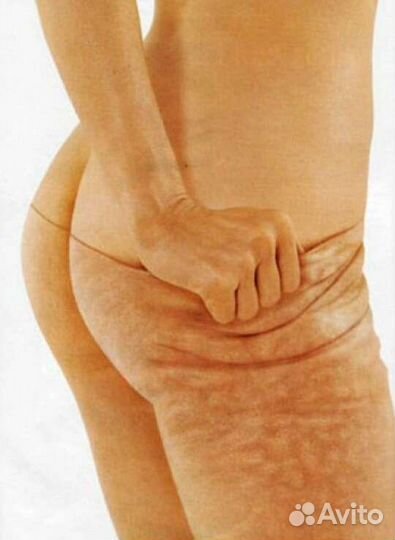 Антицеллюлитный массаж, LPG - массаж,ручной массаж