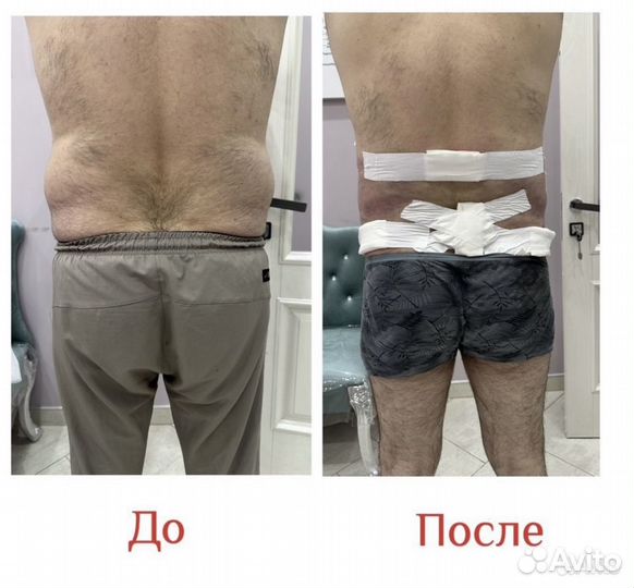 Липосакция рук