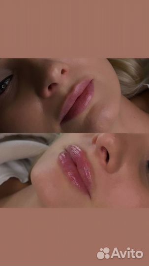 Увеличение губ