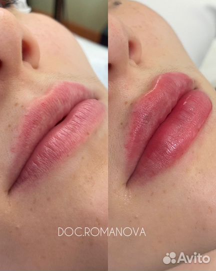 Косметолог. Увеличение губ