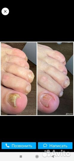 Подолог, лечебный педикюр с выездом на дом