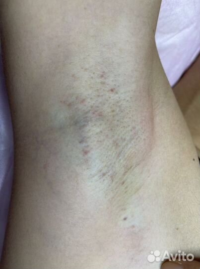 Электроэпиляция - удали навсегда волосы