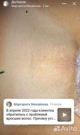 Электроэпиляция