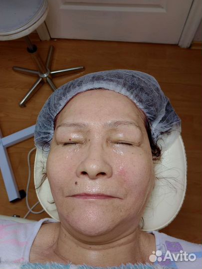 Чистка лица,пилинг,борьба с акне,постакне и др