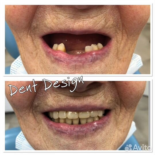 Гибкие протезы