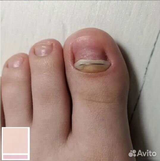 Подолог, титановая нить, вросший ноготь. Азино