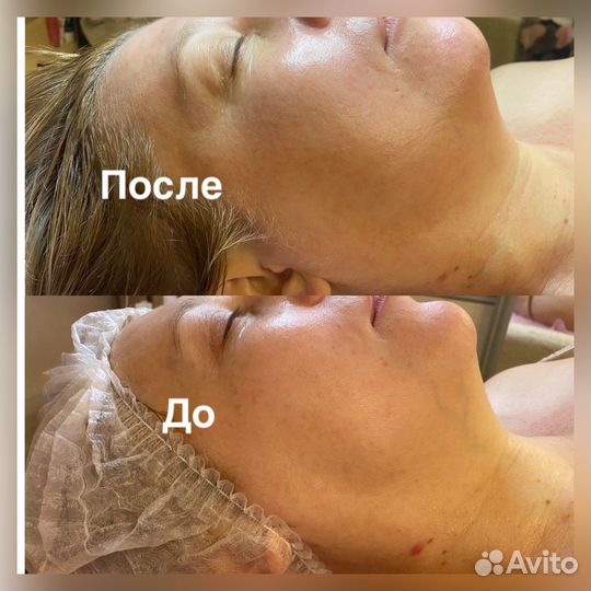 Омолаживающий массаж лица