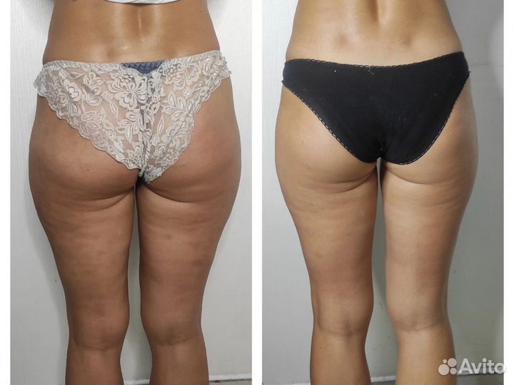 Антицеллюлитный массаж