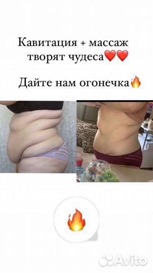 Антицеллюлитный массаж