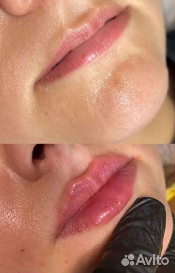 Увеличение губ, пластика губ