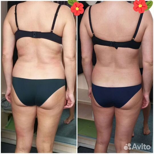 Вакумный массаж. Кавитация. Пресотерапия