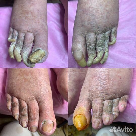 Педикюр, подолог, вросший ноготь