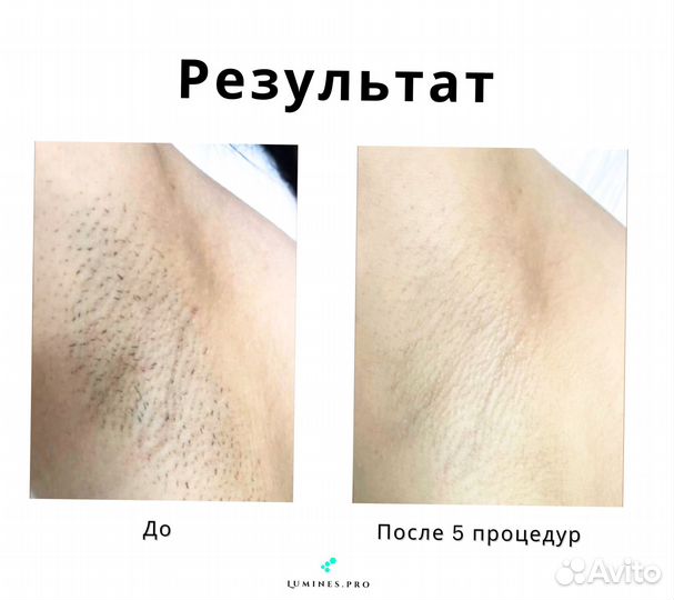 Аппарат для эпиляции Lumines. максван 1200вт