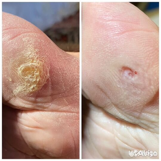 Удаление мозолей, бородавок, подолог