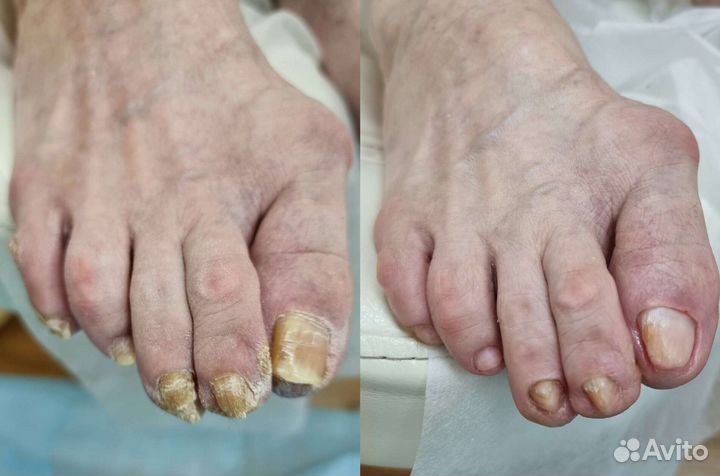 Медицинский педикюр подолог