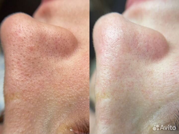 Косметолог, чистка лица, омоложение