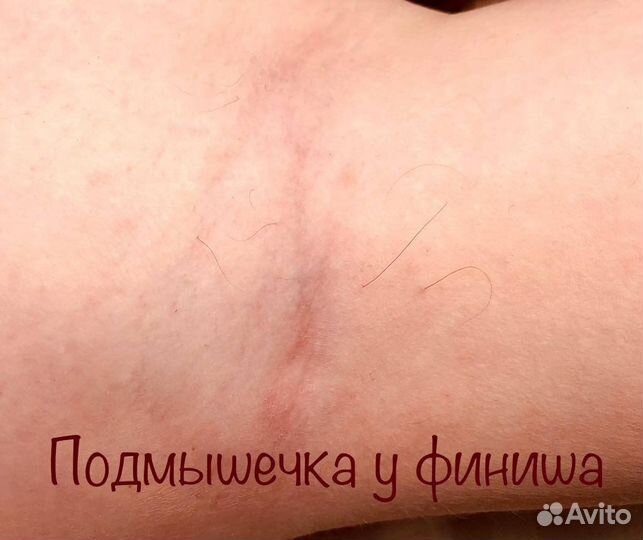 Электроэпиляция, шугаринг, воск