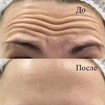 Ботокс для лица. Ботокс. Ботокс лоб Full face, Москва