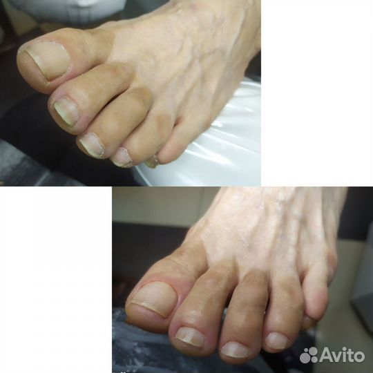 Подологический педикюр