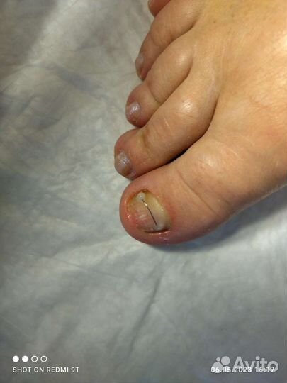 Подолог, лечебный педикюр с выездом на дом