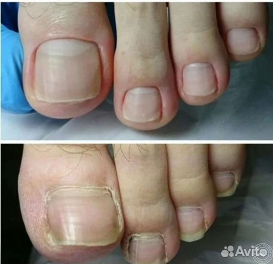 Медицинский педикюр (подолог)