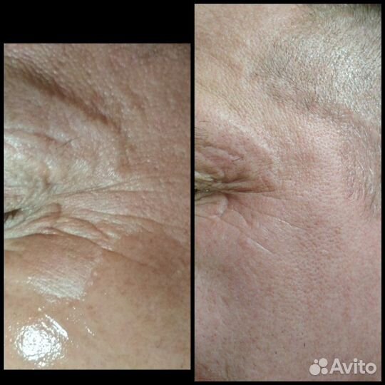 RF-лифтинг. Аппаратная косметология