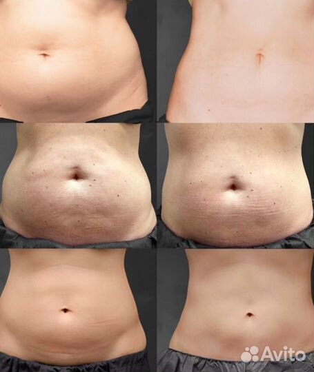 Криолиполиз / Липосакция без операций