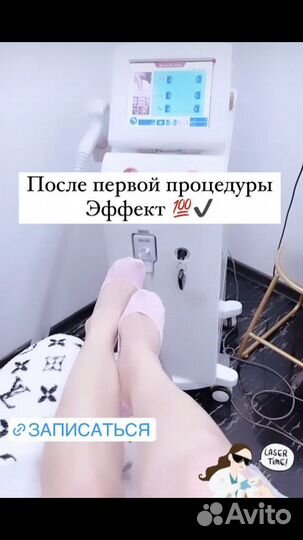 Лазерная эпиляция: подмышки