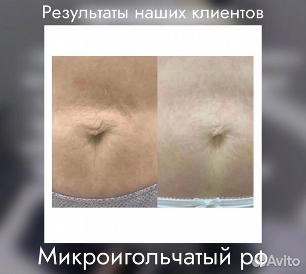 Микроигольчатый RF-лифтинг