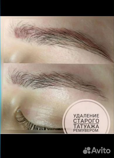 Лазерное удаление татуажа, тату, карбоновый пилинг