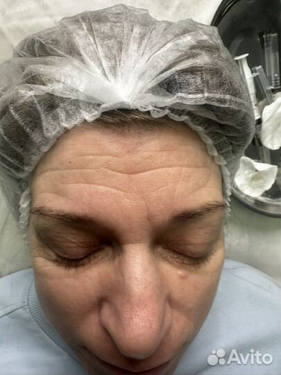 Мгновенный лифтинг лица, -10 лет за 1 процедуру