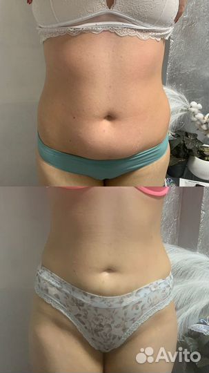 Аппаратный массаж