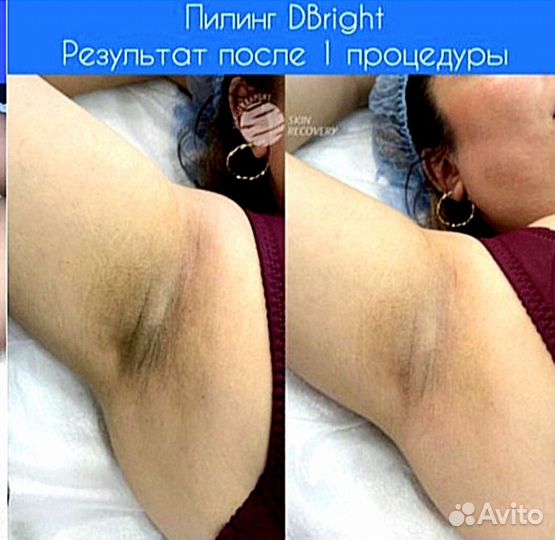 Депиляция Шугаринг Интимное омоложение Адлер