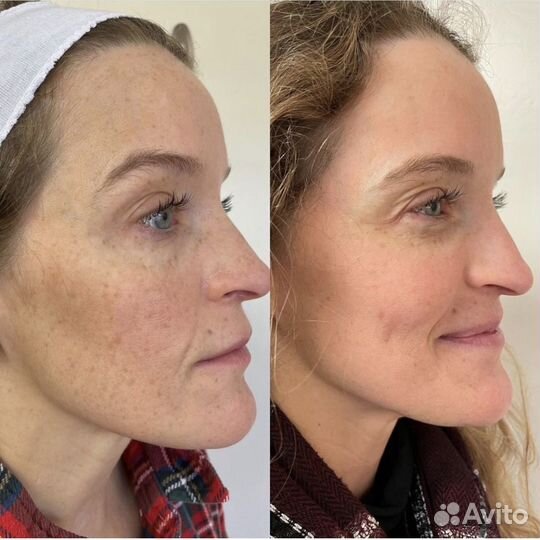 Скульптурный массаж лица + карбокситерапия