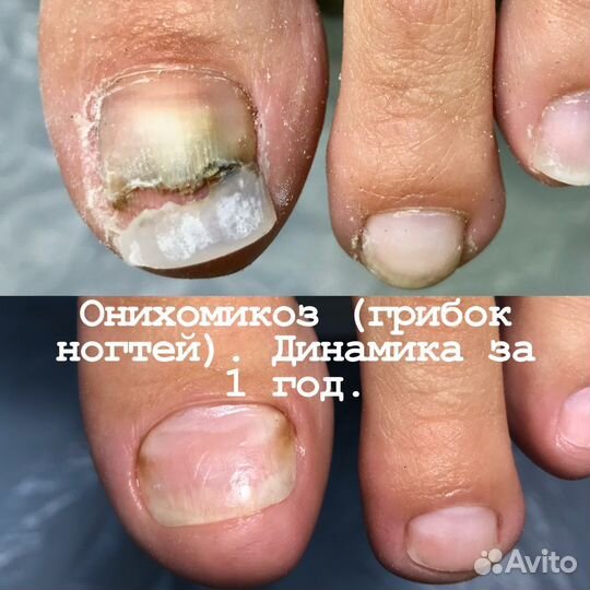 Подолог, педикюр