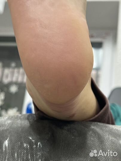 Подолог(вросший ноготь,трещины,мозоли бородавки)