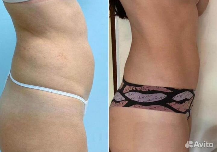 Модели на Криолиполиз боков