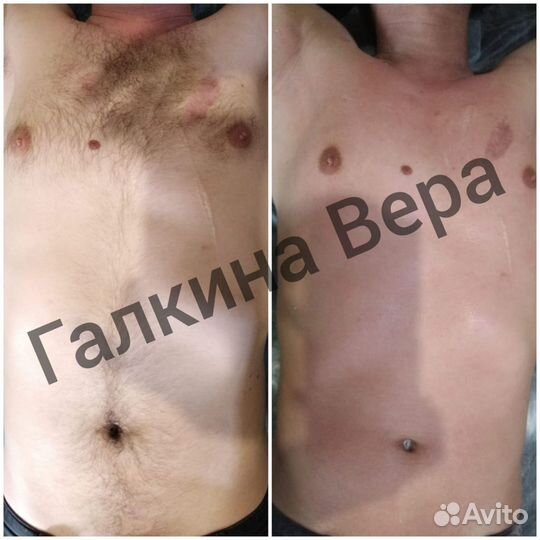 Депиляция воском