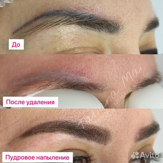 Удаление лазером татуажа и тату