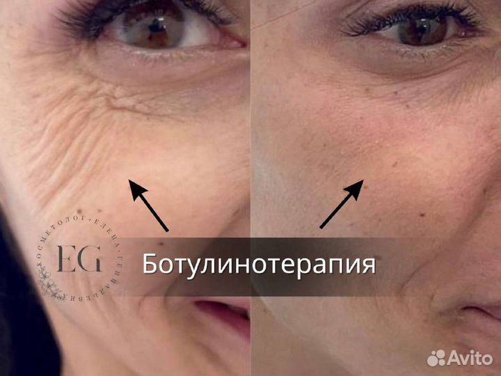 Контурная пластика. Ботокс. Диспорт. Full Face