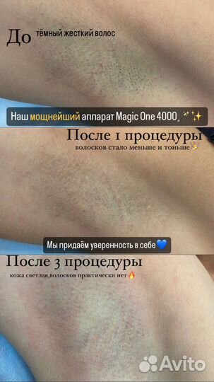 Лазерная эпиляция диодный лазер