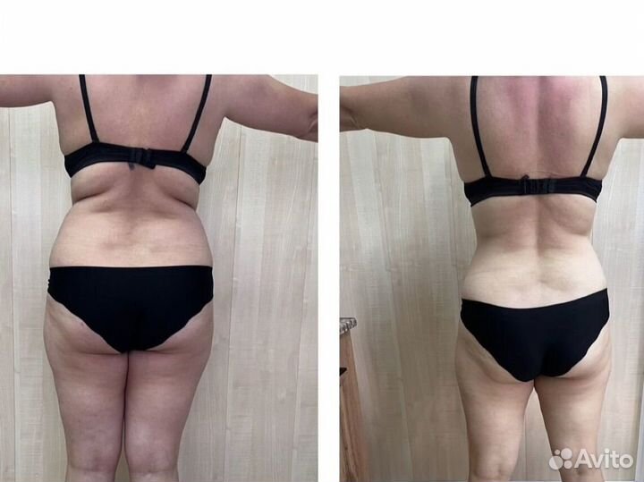 Аппаратное похудение, Массаж 