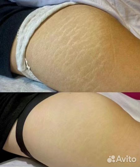 Крем против растяжек