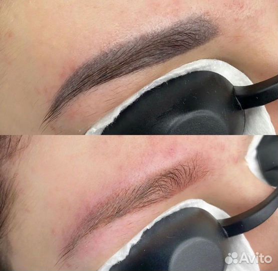 Неодимовый лазер LA15 Nd:YAG