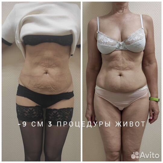 Массаж Коррекция фигуры