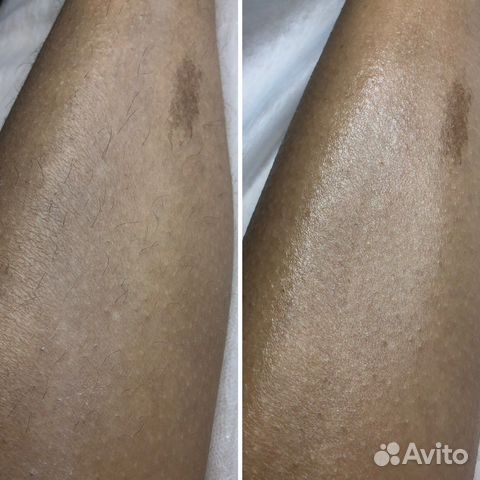 Депиляция воском: глубокое бикини