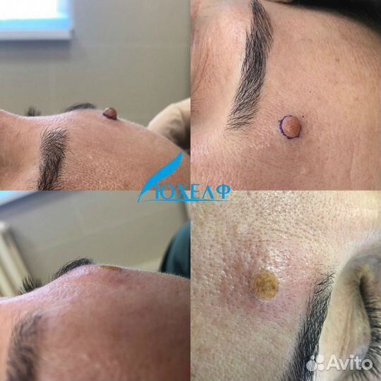 Удаление лазером родинок, папиллом, бородавок