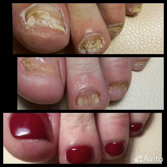 Подолог, лечебный педикюр