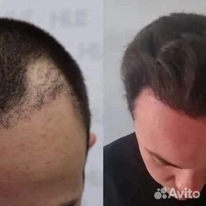 Пересадка волос Гарантия/ Качество/ Результат