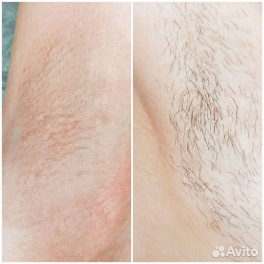 Шугаринг обучение